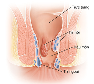 Mặt cắt của trực tràng và hậu môn thể hiện bệnh trĩ.
