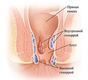 Поперечное сечение прямой кишки и заднего прохода с геморроем.