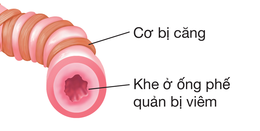 Cơ bị căng nghiêm trọng, dịch nhầy dư thừa và lớp lót ống phế quản bị viêm