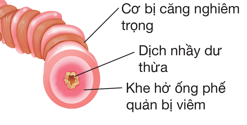 Cơ bị căng và lớp lót ống phế quản bị viêm