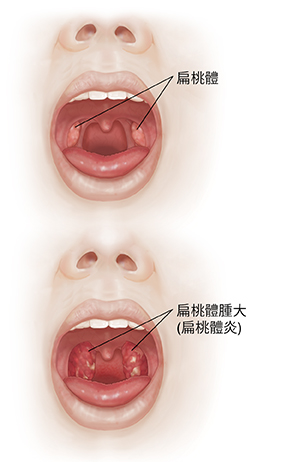 張開嘴的臉部正面圖，將口腔和扁桃腺與發炎的喉嚨和腫大的扁桃腺進行比較。