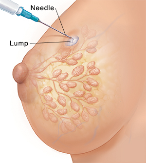 帶有管道與小葉的女性乳腺側視圖，顯示腫塊穿刺活檢。