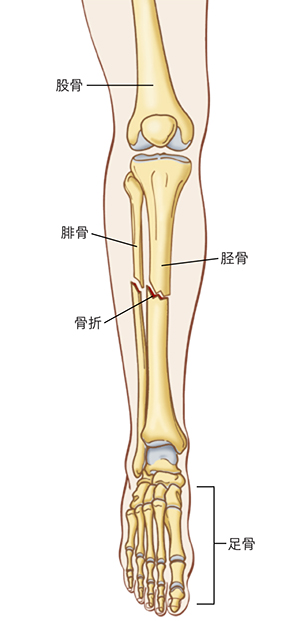 图示小腿轮廓及相关骨骼，包括股骨和足骨，并显示出腓骨和胫骨内的一处骨折