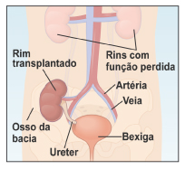esboco de abdomen humano mostrando rins com insuficiencia na parte superior do abdomen e bexiga na pelvis rim transplantado